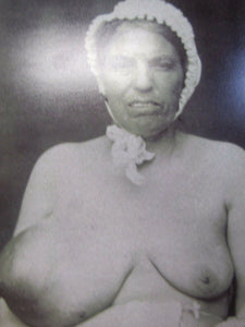 Old Medical Photo "Enormous Tumor of the Right Breast 1873" Burns Archive Print