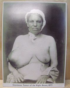 Old Medical Photo "Enormous Tumor of the Right Breast 1873" Burns Archive Print