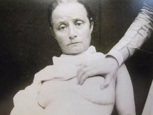 Load image into Gallery viewer, Old Medical Science Photo &quot;Breast Lumpectomy circa 1874&quot; Burns Archive NY Print
