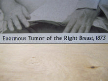 Load image into Gallery viewer, Old Medical Photo &quot;Enormous Tumor of the Right Breast 1873&quot; Burns Archive Print
